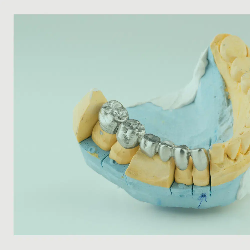 Dental mold displaying several crowns fitted onto the teeth, used for restorative dentistry planning. Dental mold displaying several crowns fitted onto the teeth, used for restorative dentistry planning.